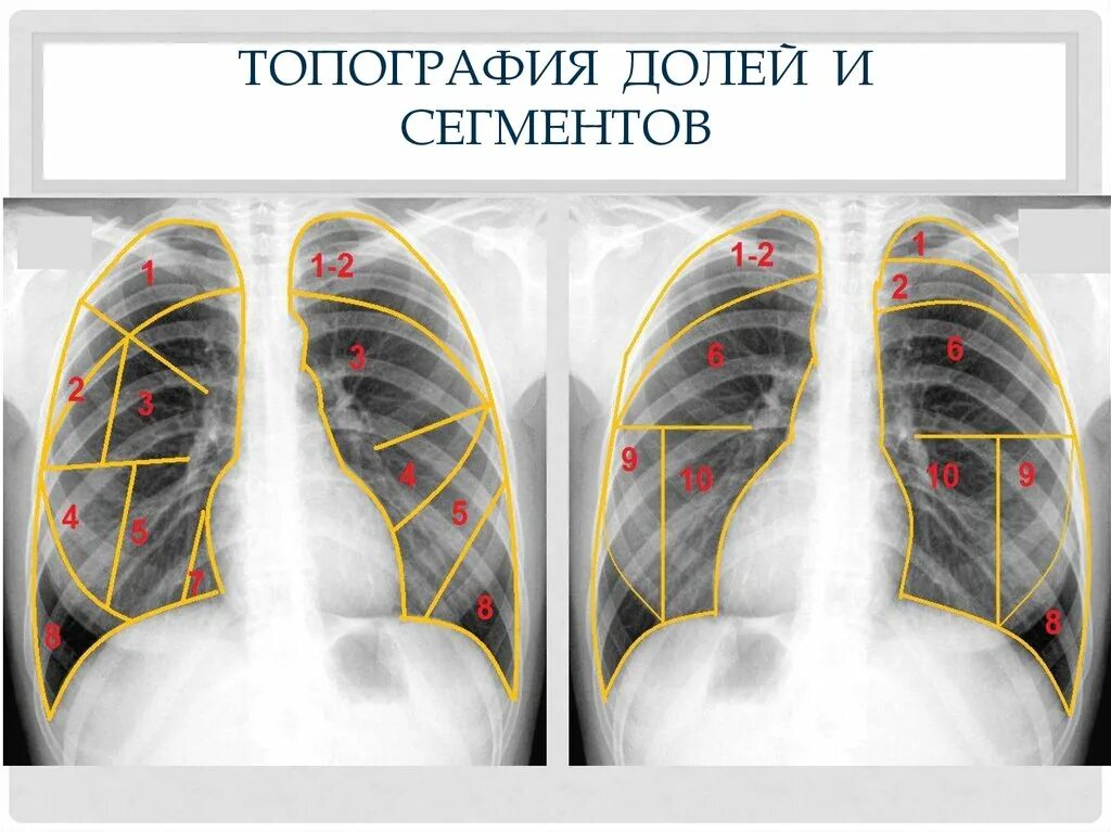 Доли легкого на рентгенограмме. Легкие сегмент s9. Ctuvtynx KTUR[ htynuty. 6, 10 Сегмент правого легкого. Сегмерты легких Рент.