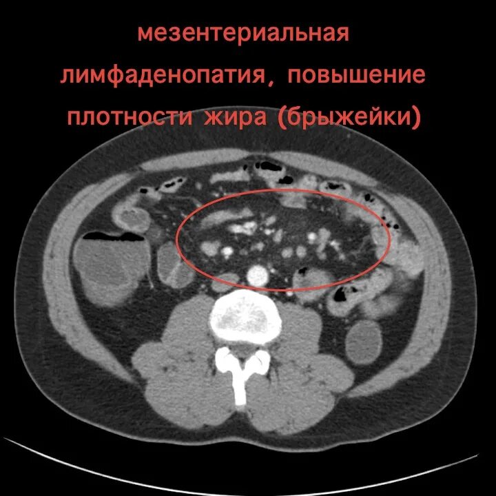 Мезентериальные лимфатические узлы на кт. Брыжеечные лимфоузлы на кт. Верхнебрыжеечные лимфоузлы на кт. Тазовая лимфаденопатия