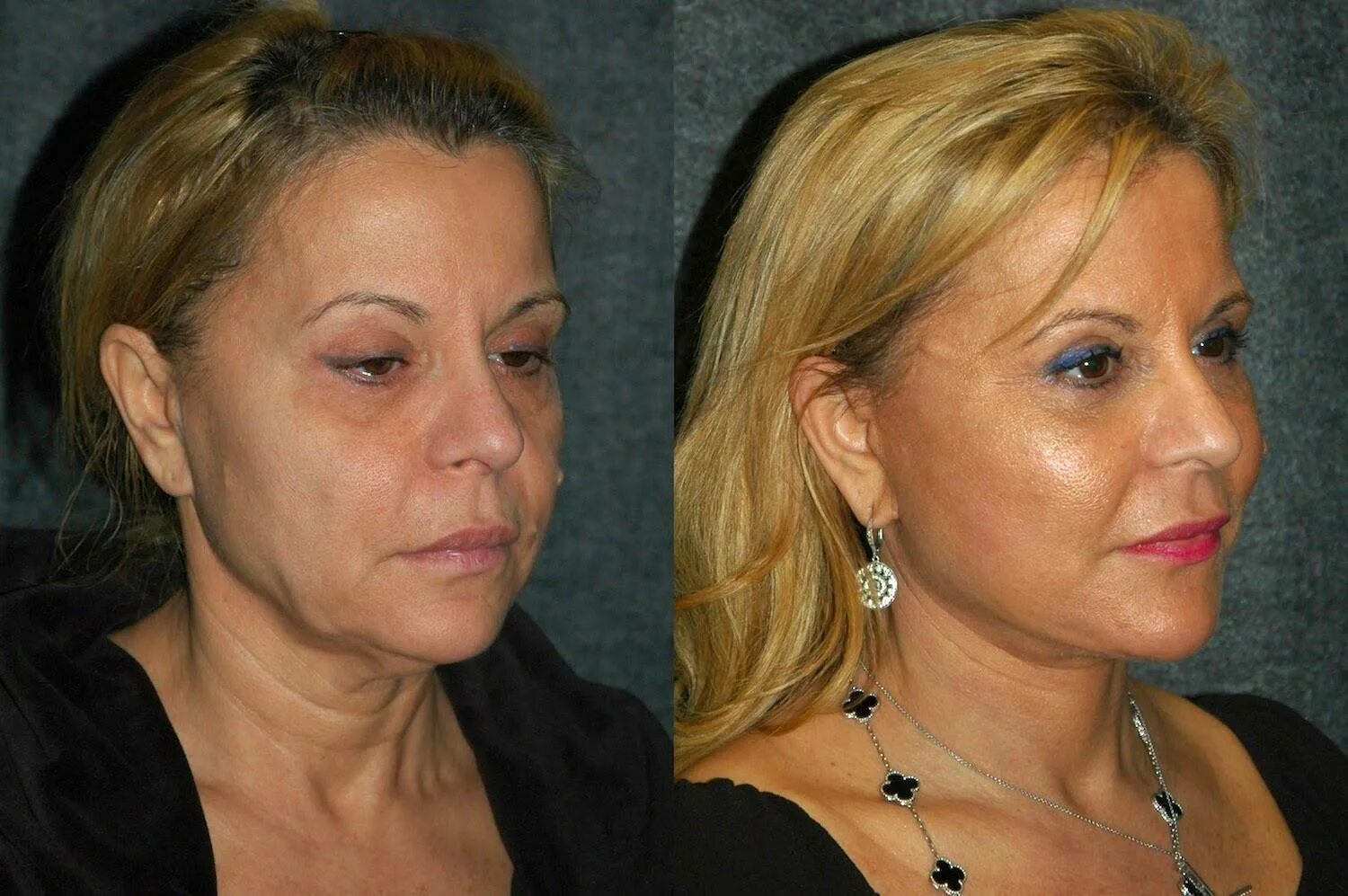 Подтяжка лица отрицательные отзывы. Подтяжка лица отрицательные отзывы. Смас лифтинг верхних век. Подтяжка лица отрицательные отзывы. Ультразвуковая подтяжка ultherapy.