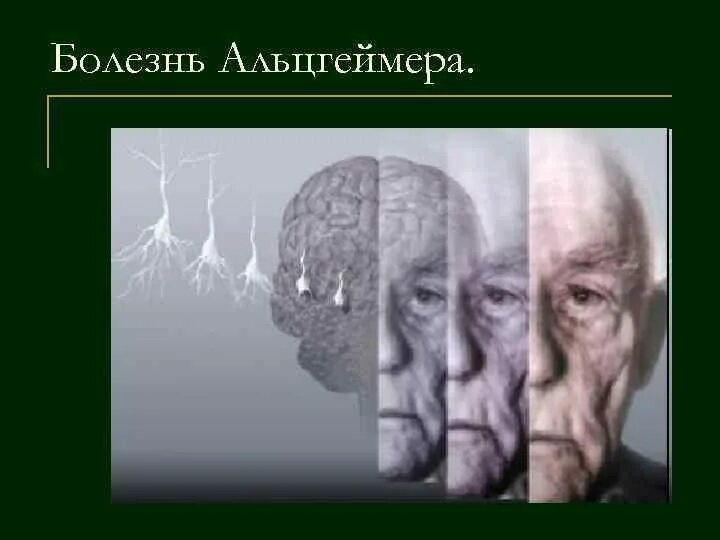 Б альцгеймера. Болезнь альцгеймера. болезнь альцгеймера презентация. нарушение памяти альцгеймер.