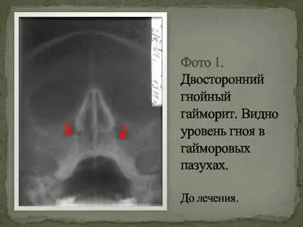 Двусторонний катаральный гайморит