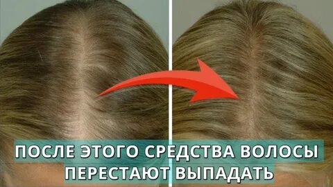 Выпадают волосы на голове народные средства