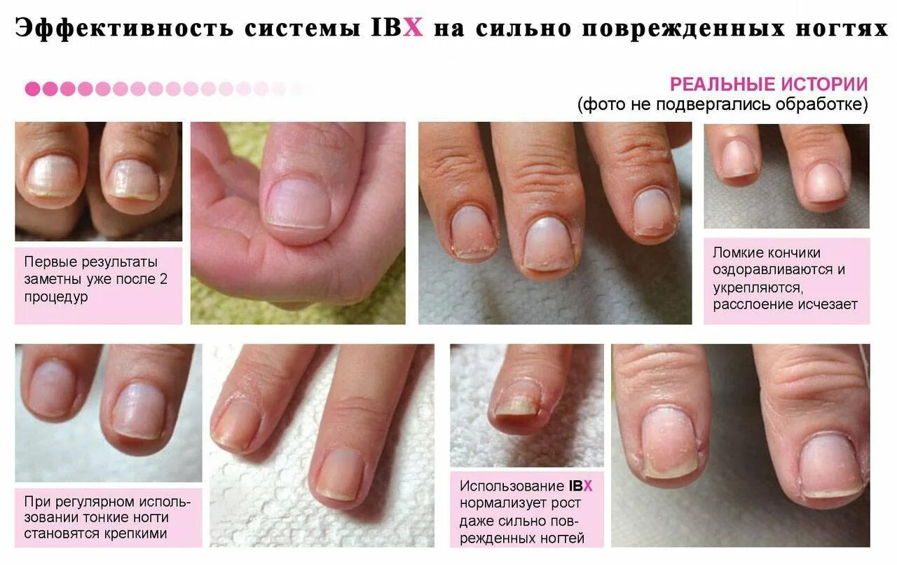 Портит ли ногти. Восстановление ногтевой пластины. Поврежденная ногтевая пластина.