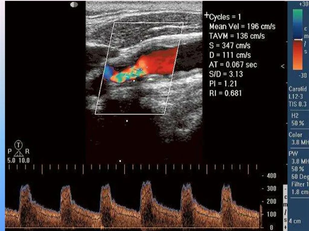 Доплер артерий. Ультразвуковая допплерография магистральных сосудов. УЗИ УЗДГ брахиоцефальных сосудов. УЗИ сосуды брахиоцефальные артерии что это такое. Ультразвуковая допплерография (УЗДГ).