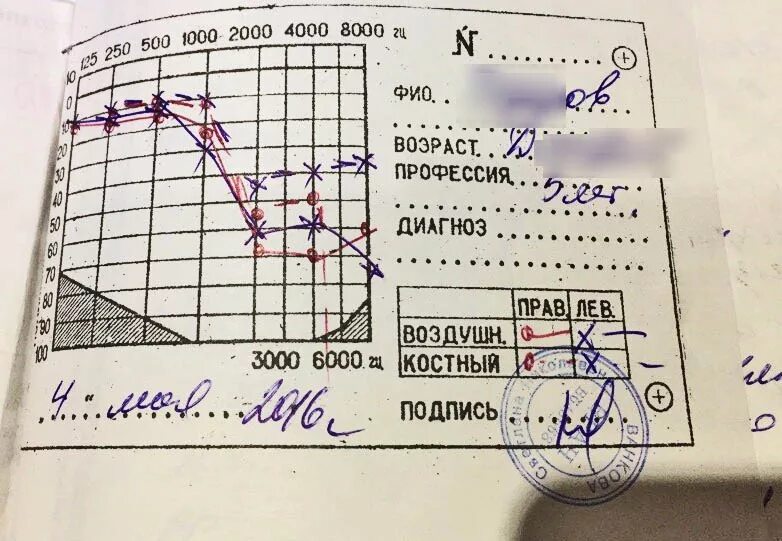 Тугоухость степени классификация. Нейросенсорная тугоухость iv степени. Международная классификация тугоухости. Степени потери слуха таблица. Степень снижения слуха классификация.