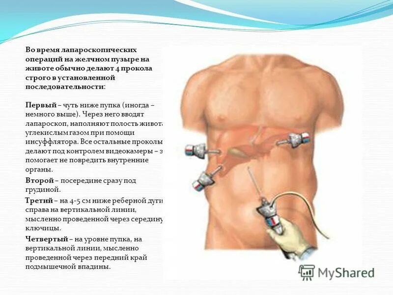 Удаление желчного пузыря отзывы врачей