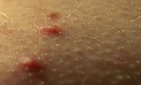 Small Red Dots On Skin Cherry Angiomas - Jameslemingthon Blog.