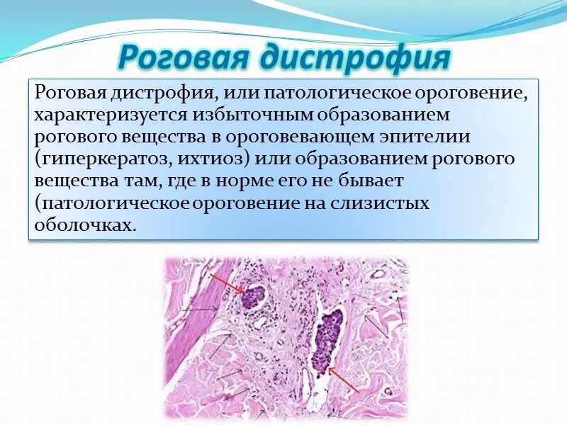 Паренхиматозная гидропическая дистрофия. Паренхиматозные белковые дистрофии гидропическая. Паренхиматозная белковая зернистая дистрофия. Паренхиматозные белковые дистрофии (диспротеинозы).