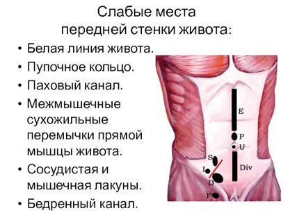 Грыжа передней стенки живота