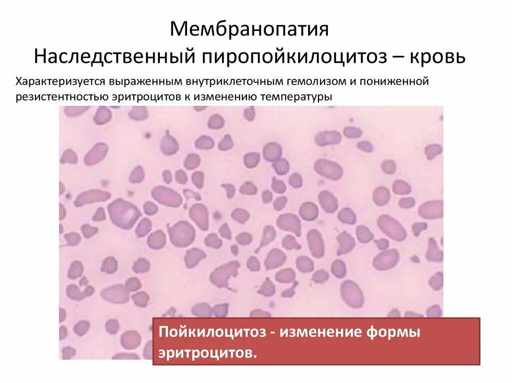 Пойкилоцитоз эритроцитов это. Пойкилоцитоз пойкилоцитоз. изменение формы эритроцитов. эритроцитарные мембранопатии.