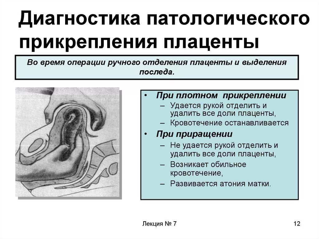 Ручное отделение плаценты и выделение последа. Приращение плаценты классификация. Операция ручного отделения плаценты. Ручное выделение плаценты. Ручное отделение плаценты и выделение.