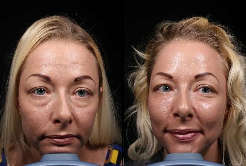 мешки под глазами после филлера. носослезная борозда малярный мешок. филлеры под глаза. Rf лифтинг носослезной борозды. Co2 лазерная блефаропластика.