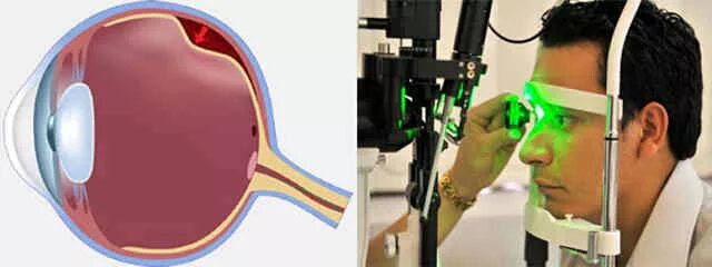 Сетчатка лазерная операция