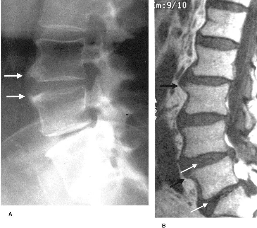 Сакрализация l5 позвонка рентген. Левосторонняя сакрализация l5 позвонка. Спондилез l1-l2 сегмента. Антелистез l5 позвонка что это такое. Спондилез l3