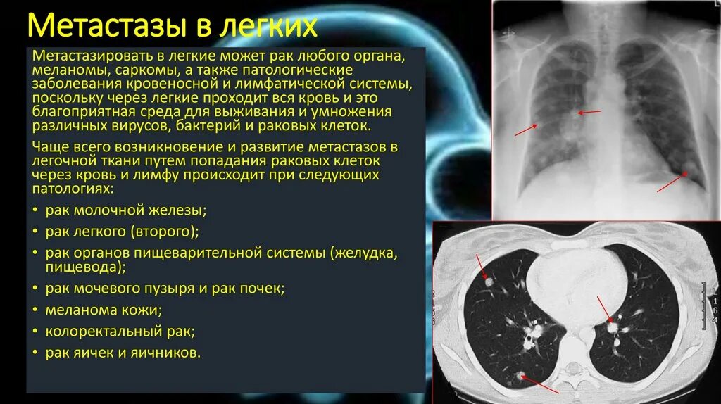 Метастазы в легких костях