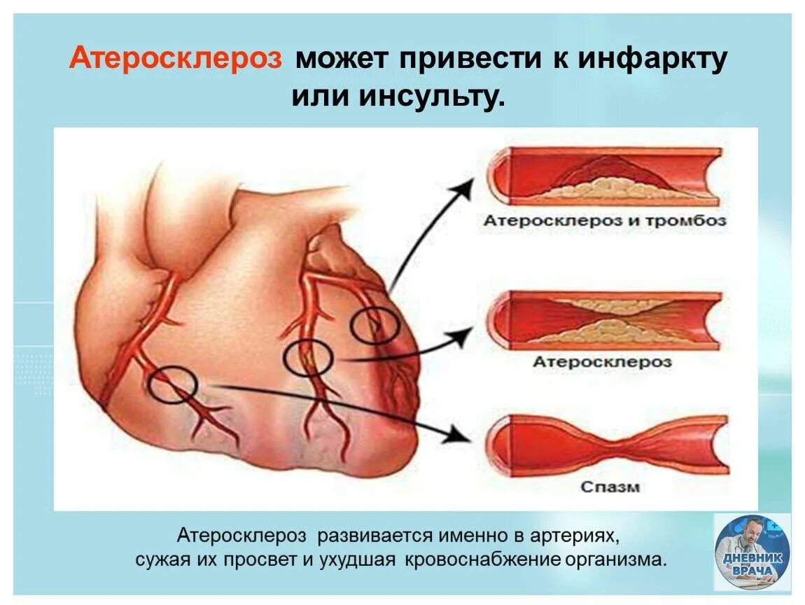 Инсульт холестерин. Атеросклероз презентация. Атеросклероз развивается.