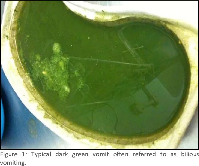 Почему блюешь водой. Желчь зеленого цвета при рвоте. Зелёная жидкость при рвоте.