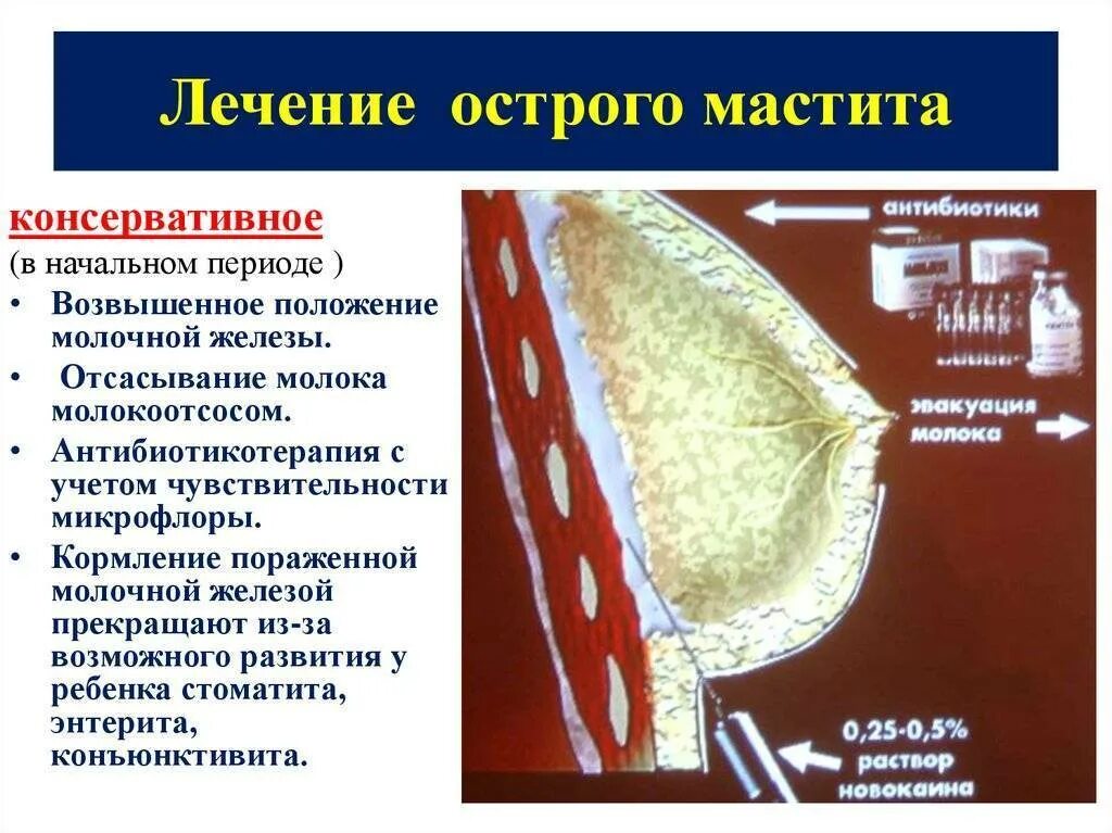 Клинические симптомы мастита. Серозная стадия мастита. Острый инфильтративный мастит. Кормящим можно мазать