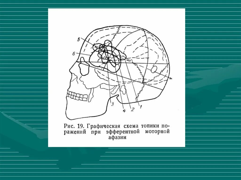 Теменные формы афазии. Локализация афазий по лурия. формы афазий по а.р лурия. классификация афазии лурия. классификация афазий а.р.лурия.
