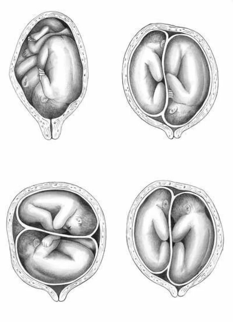 Многоплодная беременность расположение плодов. Положение плодов при многоплодной беременности. Поперечное головное предлежание плода. Предлежание плодов при многоплодной беременности. Положение плода в матке продольное