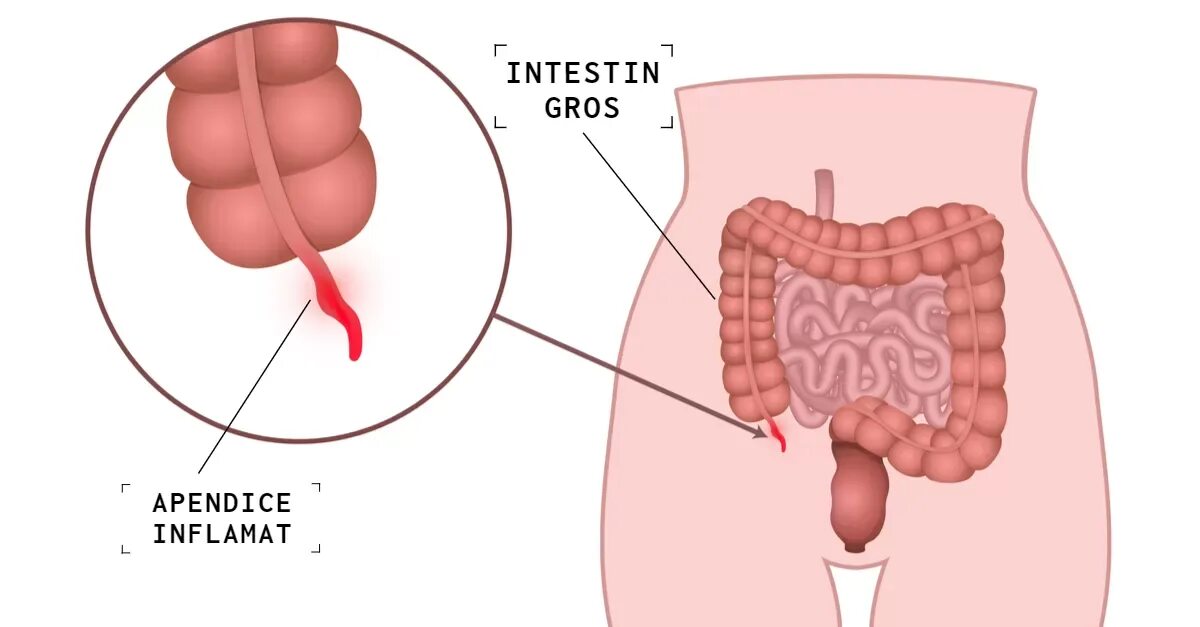 Аппендикс причины. Воспаление червеобразного отростка слепой кишки. Воспаленный аппендицит.
