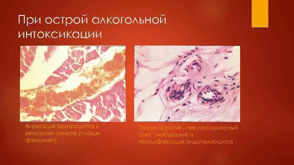 Сладж эритроцитов