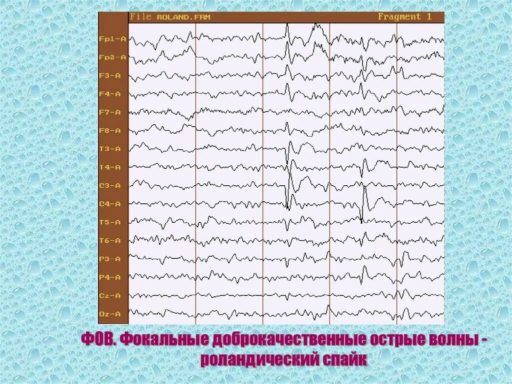 Роландическая эпилепсия ЭЭГ. Роландические комплексы на ЭЭГ. Спайки на ЭЭГ. Спайк волна на ЭЭГ. Медленные волны на ээг