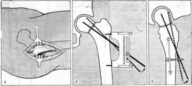 Операция остеосинтез шейки бедра. Перелом бедра остеосинтез. Перелом шейки бедра остеосинтез. Остеосинтез перелома шейки бедра канюлированными винтами.
