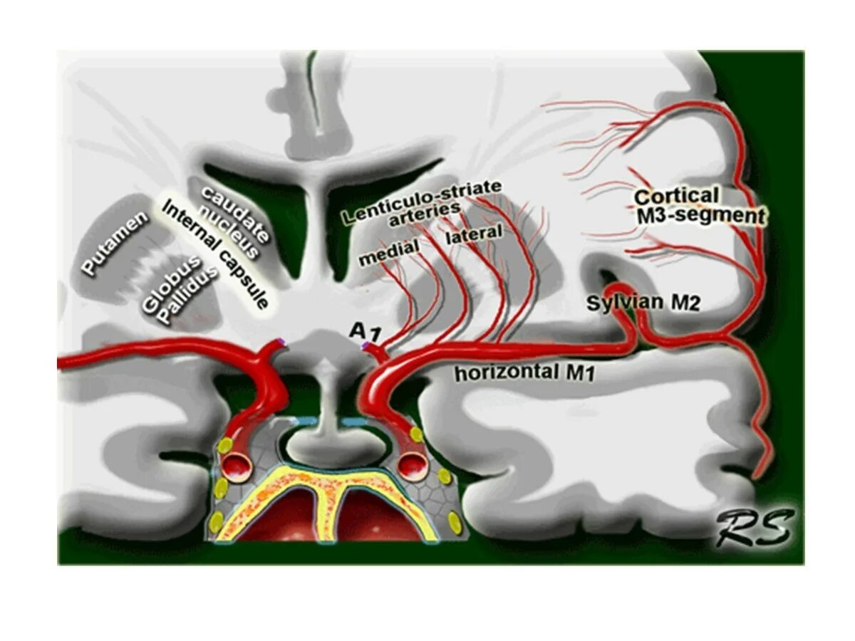 Сегмент а1 пма. М2 сегмент средней мозговой артерии. М1 м2 сегменты СМА. М1 сегмент средней мозговой артерии мрт. М1 сегмент средней мозговой артерии схема.
