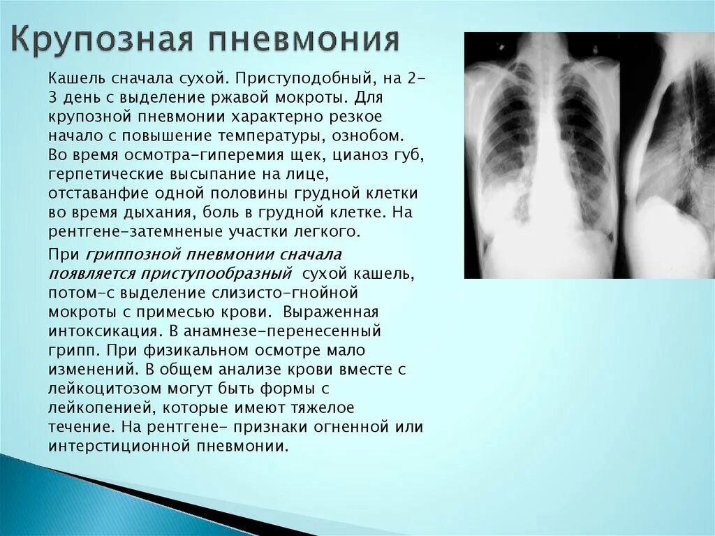 Крупозная пневмония грудная клетка. Шумы при крупозной пневмонии. Крупозная пневмония кашель. Легкие при сильном кашле