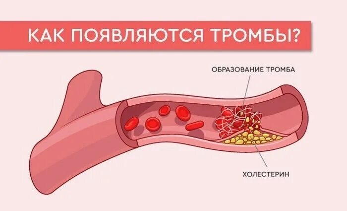 Как образуется тромб. Тромбоз схема.