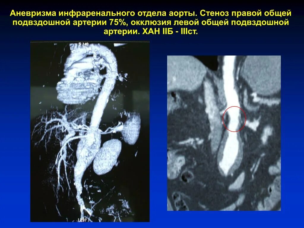 Аневризма инфраренального отдела. Мешотчатая аневризма аорты кт. Веретенообразная аневризма инфраренального отдела брюшной аорты. Аневризма бифуркации аорты. Аневризма показания к операции