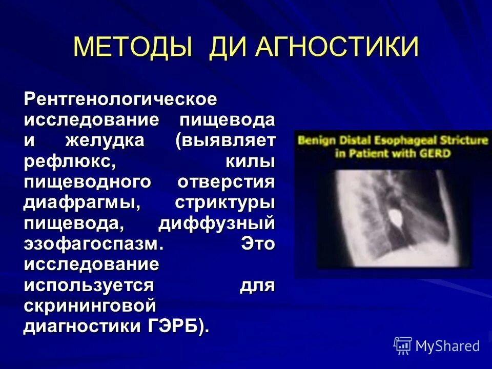 Диффузная пищевода. Рентгенологическое исследование пищевода. Рентгеноконтрастное исследование пищевода. Рентгенологические методы исследования пищевода. Методы рентгеновского исследования пищевода..