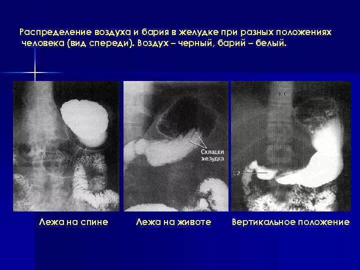 Рентгенография желудка с барием в положении Тренделенбурга. Положение желудка рентген. Воздух в желудке на рентгене. Положение газового пузыря желудка на рентгенограмме.