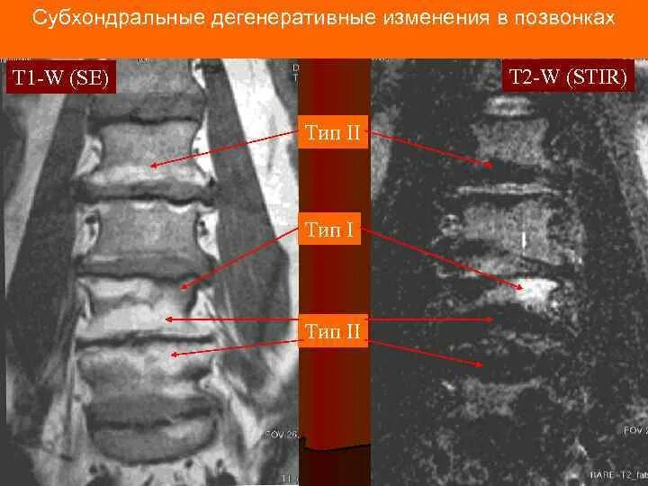 Замыкательные пластинки позвонков l1 l2 l3l4. Дегенеративные изменения позвонков мрт. Дегенеративные изменения в теле позвонка. Субхондральный склероз замыкательных пластин тел позвонков.