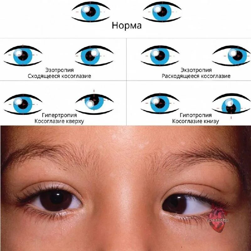 узловые точки оптической системы. точка фиксации глаза. точка фиксации глаза. нарушение бинокулярного зрения косоглазие. физиологические механизмы стереоскопического зрения.