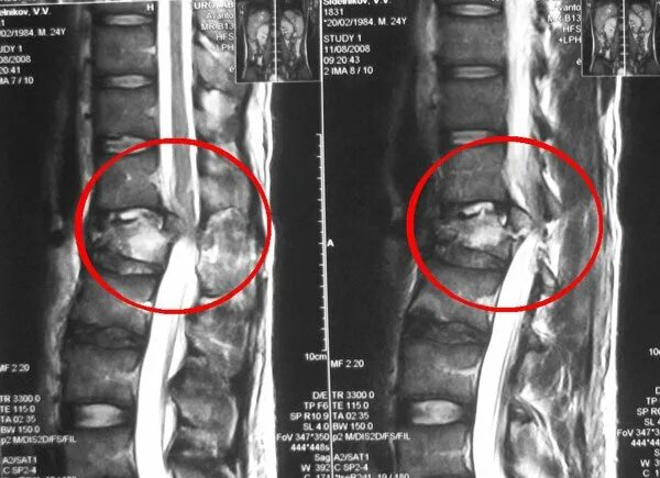 Компрессионный перелом грудного позвонка мрт. Компрессионный перелом поясничного позвонка мрт. Компрессионный перелом позвонка грудного отдела мрт. Компрессионный перелом позвоночника мрт. Опухоль в поясничном отделе