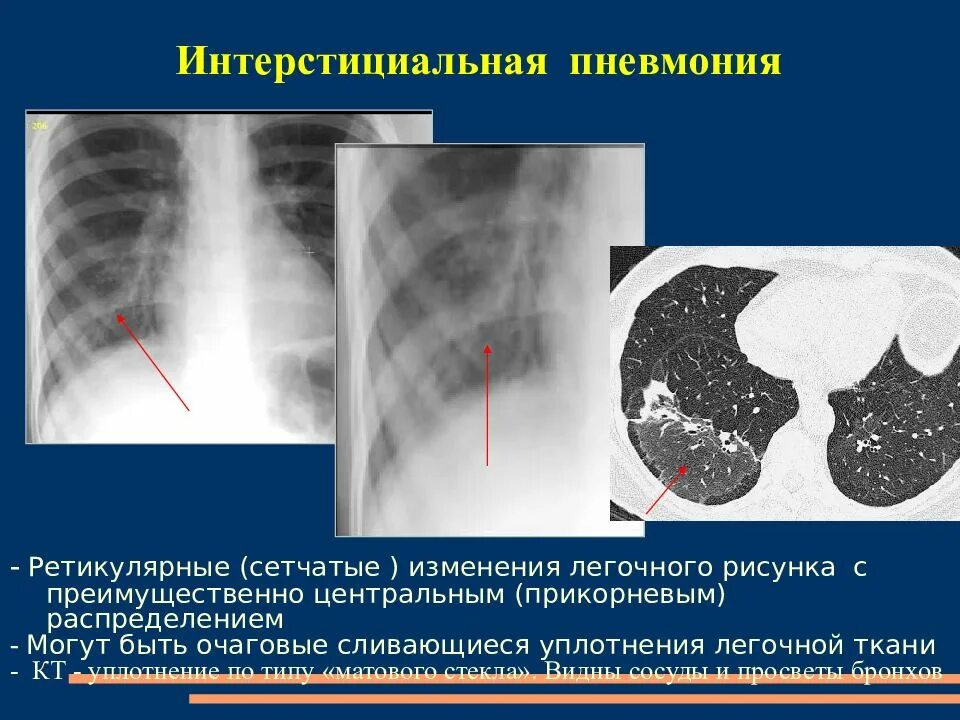 Легкие фиброзного характера