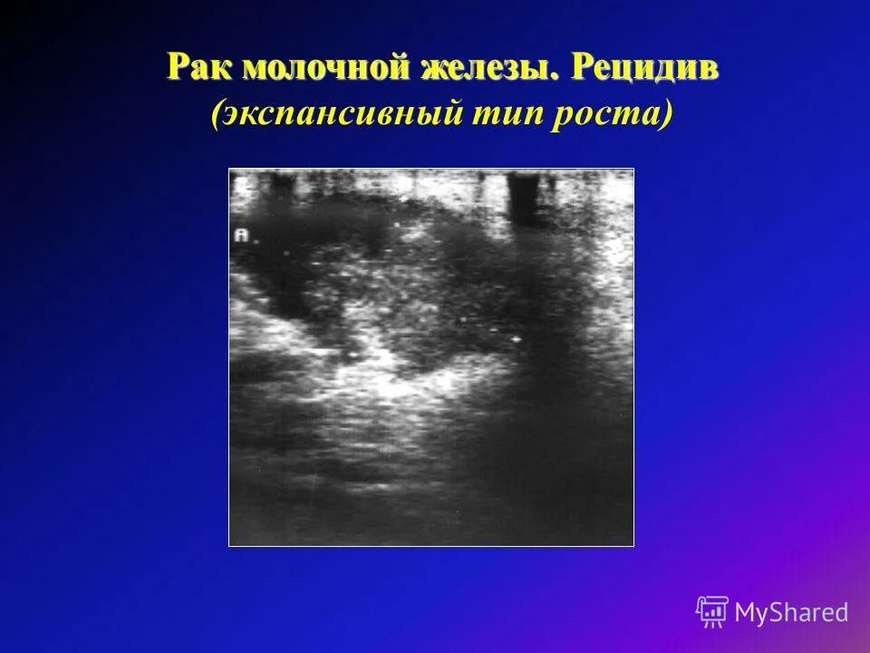 После операции опухоли молочной железы. УЗИ молочной железы РМЖ. Как выглядит рецидив РМЖ.