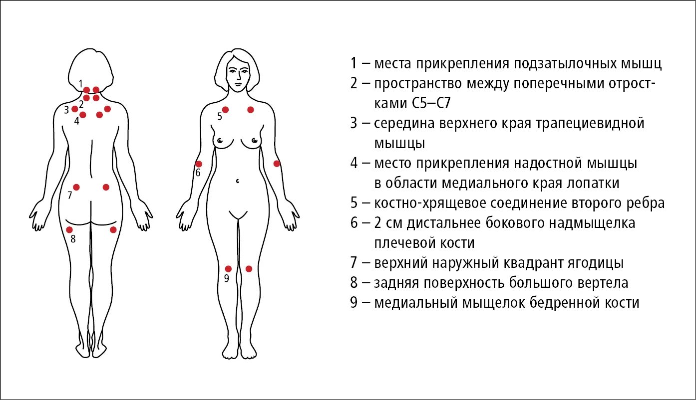 18 болезненный. Фибромиалгия болевые точки. Фибромиалгия триггерные точки схема. Болевые точки при фибромиалгии. Триггерные точки при фибромиалгии.