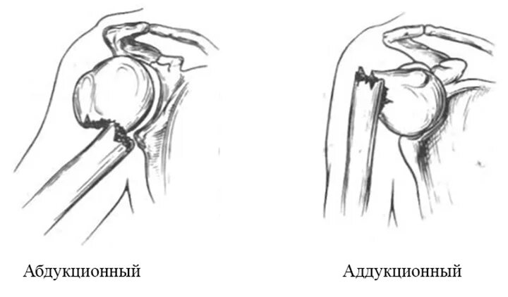 Абдукционный перелом хирургической шейки плеча. Абдукционный перелом шейки плеча рентген. Перелом шейки плечевой кости рентген. Вколоченный перелом головки плечевой кости. Перелом плеча пластина