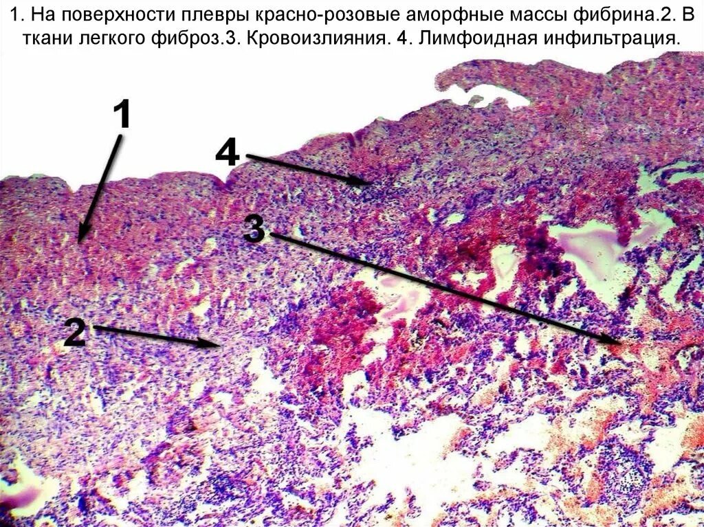 Лимфоидная инфильтрация что это. Экссудативное воспаление гистология. Пневмофиброз гистология. Мезотелиома гистология.