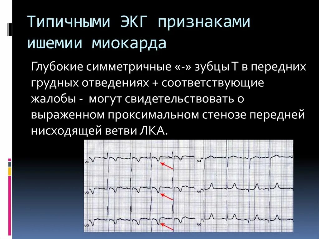 Болезни на экг