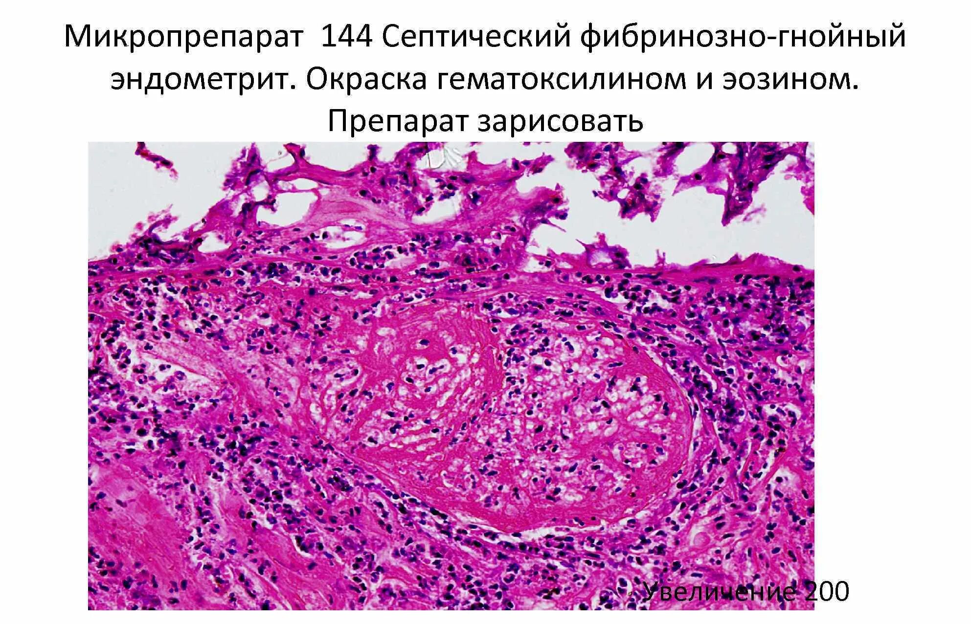 Воспаление слизистой оболочки матки. Септический межуточный миокардит микропрепарат. Гнойный эндометрит патанатомия. Что такое фибринозный эндометрит гистология. Острый Гнойный эндометрит патанатомия.