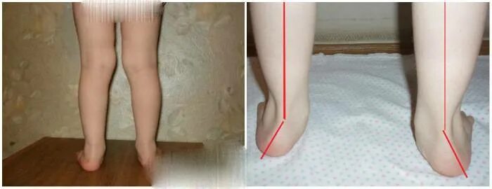 Вальгусная деформация коленных суставов у ребенка. Вальгусная деформация х образные ноги. вальгус коленных суставов у детей. рекурвация коленного сустава у ребенка. вальгус коленных суставов.