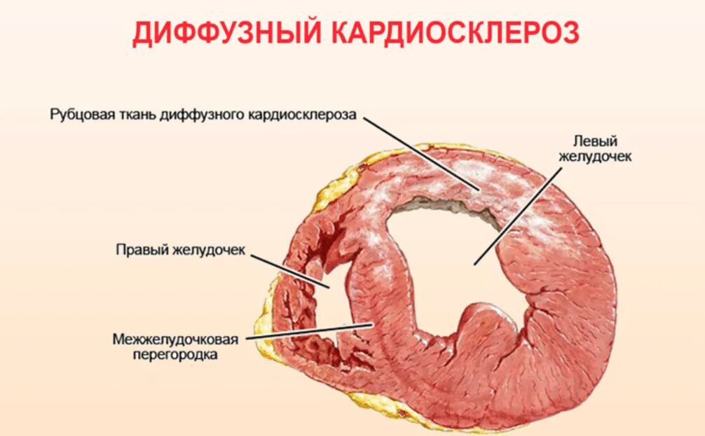 Признаки постинфарктного кардиосклероза