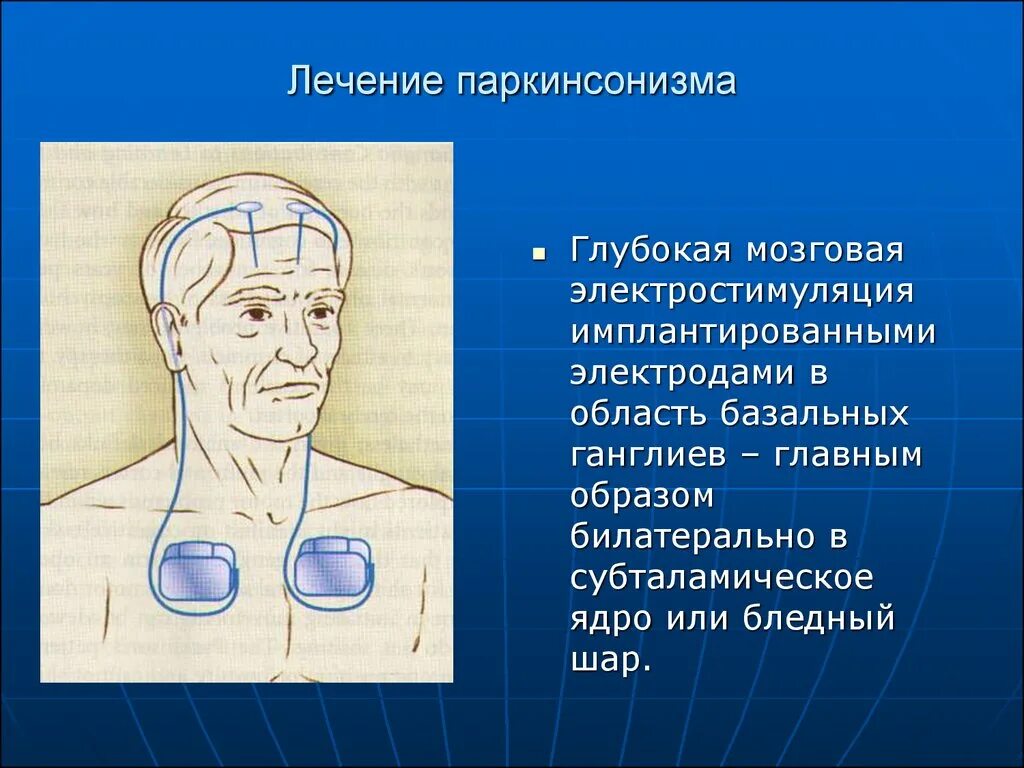 Болезнь Паркинсона. Электростимуляция болезни Паркинсона. Лечение паркинсонизма. Глубокая электростимуляция базальных ганглиев. Лечение болезни паркинсона москва