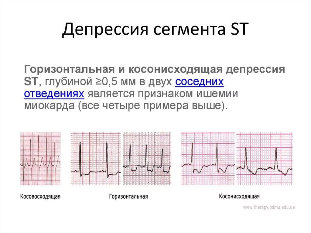 Неспецифические изменения нижней стенки. Депрессия сегмента St в 1 отведении. ЭКГ горизонтальная депрессия сегмента St. Депрессия сегмента St в 3 AVF. Горизонтальная депрессия сегмента St до 1.6 мм.