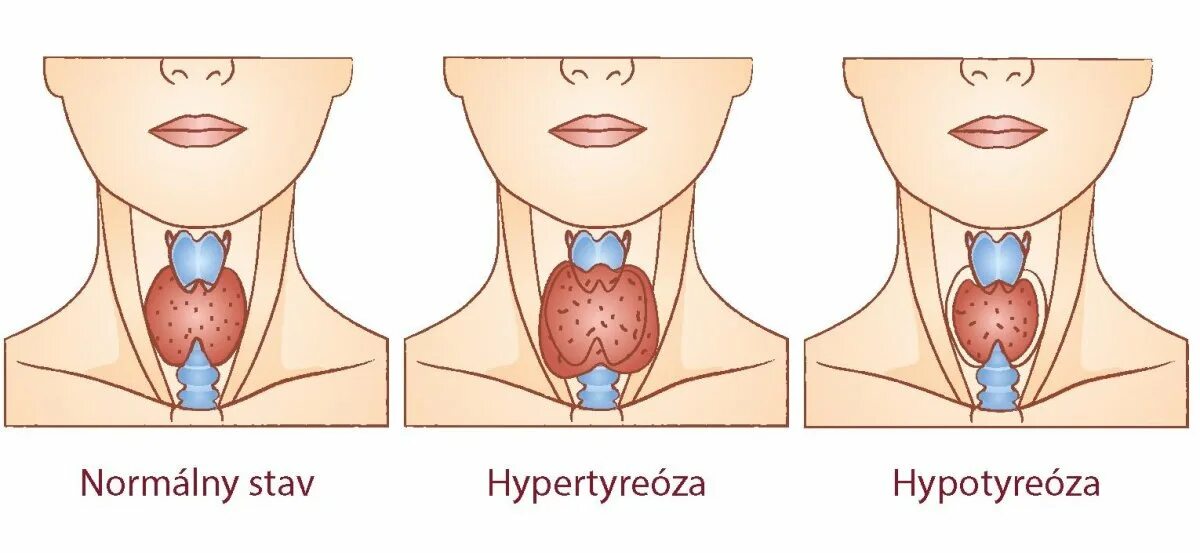 Патология щитовидной железы. Гипотиреоз. Гипофункция щитовидной железы зоб. Гипотиреоз и гипертиреоз щитовидной железы. Щитовидная железа в норме и при гипотиреозе.