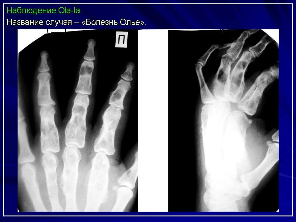 Хондроматоз костей (болезнь оллье). Хондрома кости на рентгене. Болезнь олье у детей клинические рекомендации. Болезнь олье. Болезнь олье.